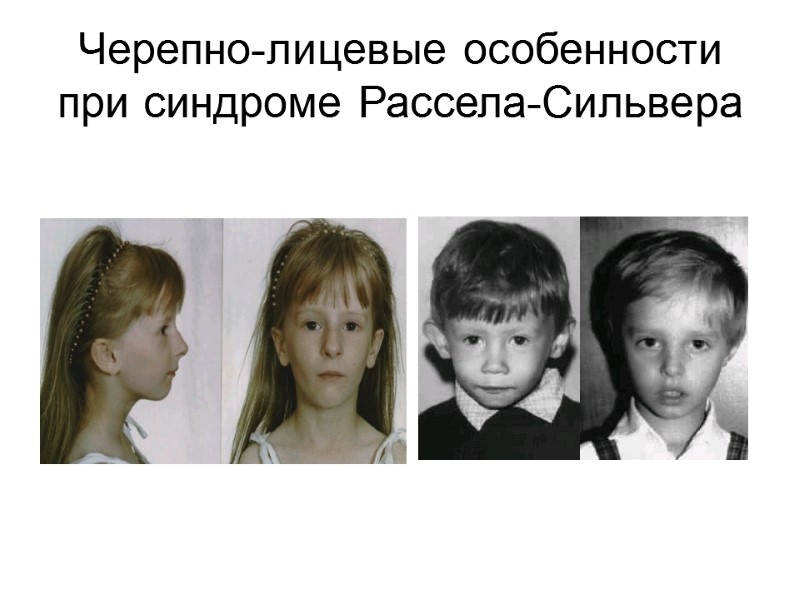 Черепно-лицевые особенности при синдроме Рассела-Сильвера